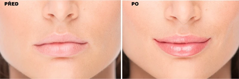 FacEvolution LipPlus Booster – Image 4